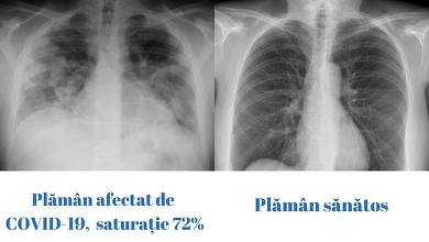 Comitetul de coordonare a vaccinării prezintă diferenţa dintre un plămân sănătos şi unul afectat de COVID, cu saturaţie de 72%, la un pacient de 23 de ani: Tot mai mulţi tineri au ajuns să fie internaţi la terapie intensivă